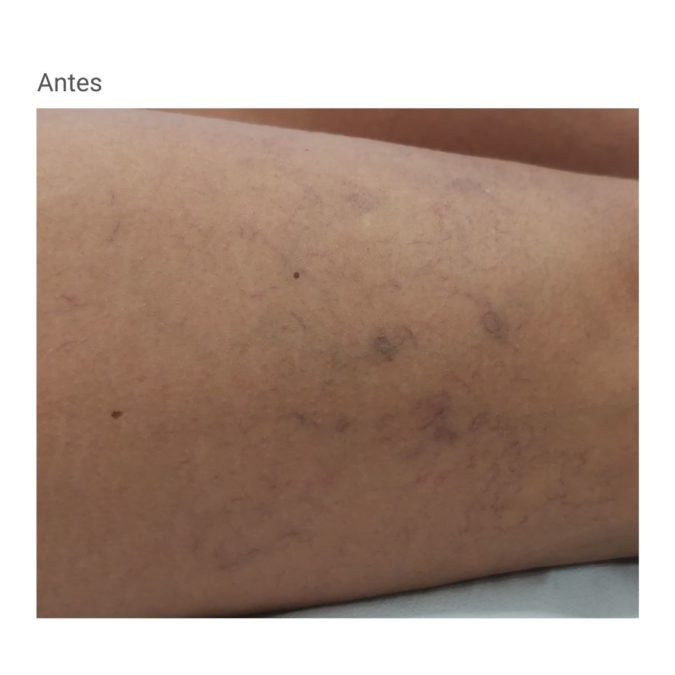 Especialista en tratamiento de varices