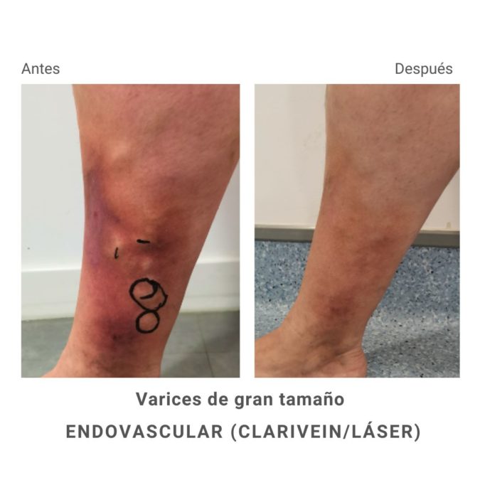 Varices de gran tamaño