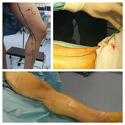 Tratamiento endovascular de varices