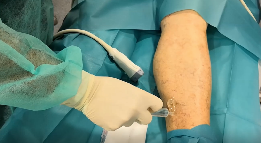 Varices en piernas