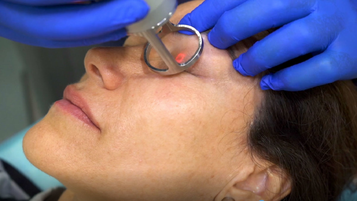 Tratamiento láser facial