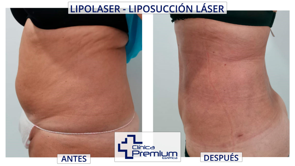 Resultados laserlipólisis